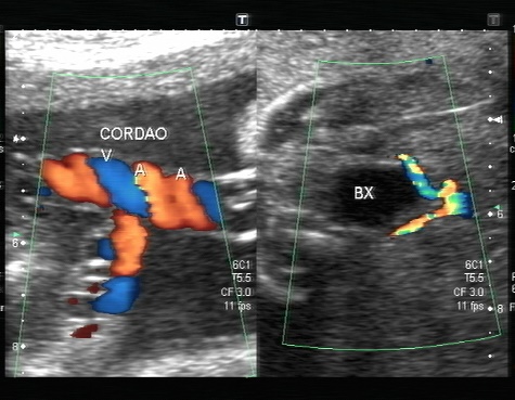 Ultrassom morfológico de segundo trimestre Espaço Morgana Kummer